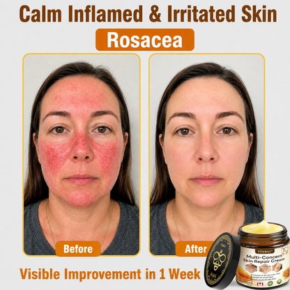✨HISKIN® Multi-Concern Skin Repair Cream (One powerful cream to repair inflammation, dryness, aging, pigmentation, and visible skin damage.)